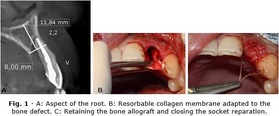 Reparación atípica de alveolo en rehabilitación estética implantológica | Rev Cubana Estomatol